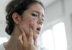 Yüzdeki iltihapları anında kurutuyor! Cildi bebek gibi yapan doğal ilaç