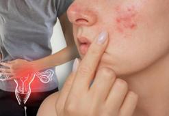 Regl döneminde akne çıkıyorsa erkeklik hormonu devrede! Androjen nedir?