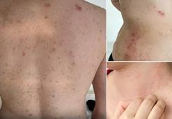 Türkiye'de uyuz alarmı! '2-3 aydır vakalarda artış var'