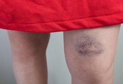 Kol ve bacaklarınız çabuk morarıyorsa dikkat! ‘Lipödem habercisi olabilir’