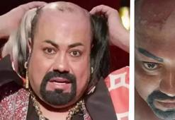 Protez saçı, başına bela oldu! Kobra Murat enfeksiyon kaptı