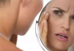 Kelebek Hastalığı (Lupus) nedir, belirtileri nelerdir? Kelebek Hastalığı tedavisi nasıl uygulanır?