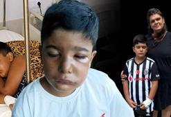 8 yaşındaki Rüzgar'ın dişi çekildi: Gözleri kapandı, hayatı kabusa döndü