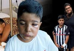 8 yaşındaki Rüzgar'ın dişi çekildi: Gözleri kapandı, hayatı kabusa döndü