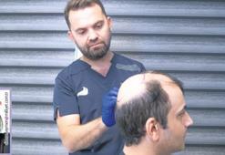 Saç dökülmesi nedenleri ve tedavi yöntemleri