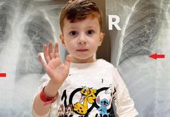 Doktorlar bile şaşkına döndü! Nefes borusundan çıktı: Tam 3 yıl onunla yaşamış