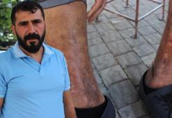 Yanlış tedavi hayatını kararttı! Yaralarım günden güne büyüyor