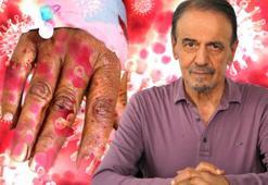 Prof. Dr. Ceyhan'dan 'maymun çiçeği' varyantı uyarısı: Herkeste görülüyor, tedavisi yok