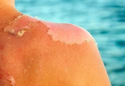 Cilt tonunu öğrenmeden güneşe hayır! Etkisi ağır oluyor, çaresi bu kremde