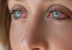 Kızarıklık, kaşıntı, yanma! Hem çocuklarda hem de yetişkinlerde görülüyor