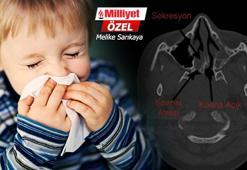 Bitmeyen burun akıntısının sebebi 'koanal atrezi' olabilir! 8 bin doğumda bir görülüyor