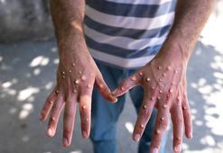 Kongo'ya 50 bin doz maymun çiçeği aşısı gönderildi