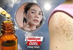 Yüzdeki inatçı melazma lekelerine son veren maske! 6 ayda cilt tonunu eşitliyor