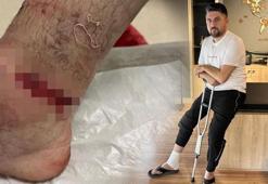 Pitbull saldırısına uğradı! 'Ayağım koptu zannettim'