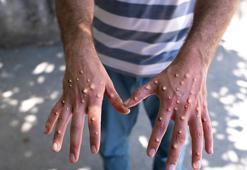 Hindistan’da ilk maymun çiçeği vakası görüldü