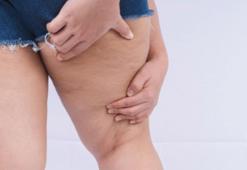 Kadınların gizli düşmanı: Lipödem!