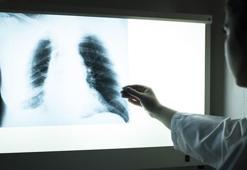 Dünya Sağlık Örgütü, 2023 yılı tüberküloz verilerini açıkladı