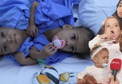 Türk doktorlar başardı! 18 aylık yapışık ikizler 9 saatlik operasyonla ayrıldı