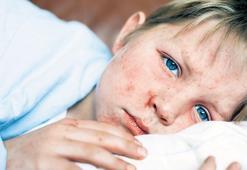 Dünyada kızamık alarmı! 10 milyonu aştı...