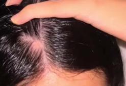 Kafasındaki kel noktayı 1 ayda yok etti! Dökülmeyi anında kesen kür tarifi