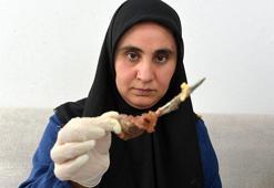 Gerçek röntgende ortaya çıktı! 7 yıl karnında makasla yaşadı