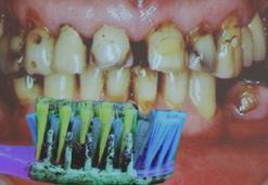 Tedavi ettiği vakalardan çarpıcı fotoğraf paylaştı! 6 kişilik aile aynı diş fırçasını kullandı