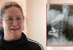Zayıflamak için ameliyata girdi, doktorları şoke etti! 'Mide ortada yoktu'