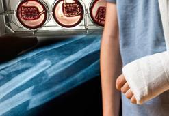 Kırık kemikler alçıyla değil kanınızla kaynayacak! Türkiye'de uygulanabilir: 'Afetlerde kurtarıcı'