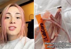 Dünyada tek olacak! Aldırdığı kaburgalarından kendine taç yaptıracak