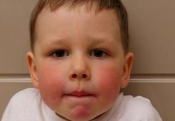 Çocuklarda besin alerjisi 2-3 kat arttı! Belirtiler günler sonra bile başlayabiliyor