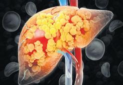 Karaciğer yağlanmasına dikkat!