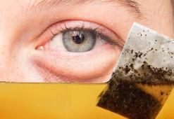 Göz altı torbası değil yağ fıtığı! Çaresi poşet çayda saklı