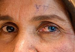 ‘Asla göremezsin' dediler! Operasyon sonrası iki farklı göz rengine sahip oldu