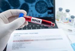 DSÖ, M çiçeği virüsünün halk sağlığı acil durumu oluşturmaya devam ettiğini bildirdi