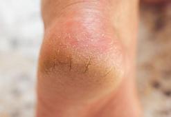 Ayaklarınızdaki yorgunluğu atın! Topukları yumuşacık yapıyor