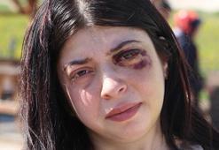 Taciz edildi, sokak ortasında dövüldü: 3 ay sıvı ile besleneceğim