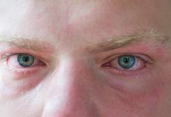 Ağlamaktan şişen gözler anında sönecek! İyi hissettiren kafein devrede