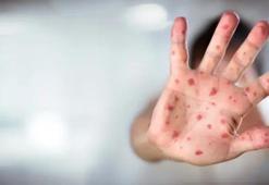 ABD'nin Teksas eyaletindeki kızamık salgını