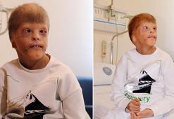 Gözleri kurtarılan Myhailo'ya şimdi kulak kepçesi yapılacak