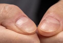Biotin eksikliği böyle anlaşılıyor! Tırnaklarınızdaki bu detaya dikkat edin