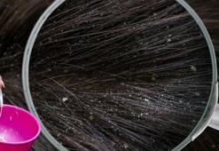 Saçta da bahar temizliği şart! Yüzde 90 işe yarıyor, kepek eriyip gidiyor