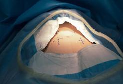 Karın germe sonrası bunlara dikkat! Uzmandan altın tavsiyeler: Ameliyatla iş bitmiyor