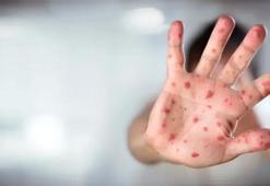 ABD'nin Texas eyaletinde kızamık salgını! Vaka sayısı 624'e yükseldi