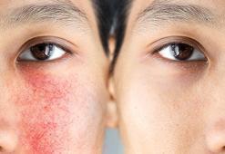 Kızarıklık, kaşıntı, kuruluk kabusunuz olmasın! Hassas ciltler için nem bombası