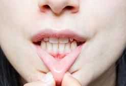 Diş eti çekiliyorsa kemik de eriyordur! Uzmanı açıkladı: Nedeni diş taşı