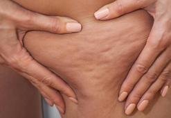 Cildiniz portakal kabuğu görünümündeyse dikkat! Selülit değil, lipödem olabilir