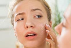 Her sivilcenin bir anlamı var! Çözülürse şıp diye geçiyor, aşırısı zarar