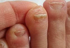 Tırnak mantarını tedavisi sabır gerektiriyor! Önlemenin yolu bu çoraplardan geçiyor