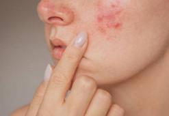 Tedavi edilmeyince tekrarlıyor! Sivilceyi kurutmanın püf noktaları