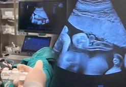 Bebeğini kaybetti, 2’nci kez hamile kalınca doktorlar fark etti! 'Anne karnında transfer ettik'